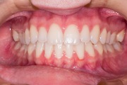 Benefits of Getting Dental Implants in Bardhaman