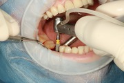 Everything To Know About Dental Implants in Bardhaman